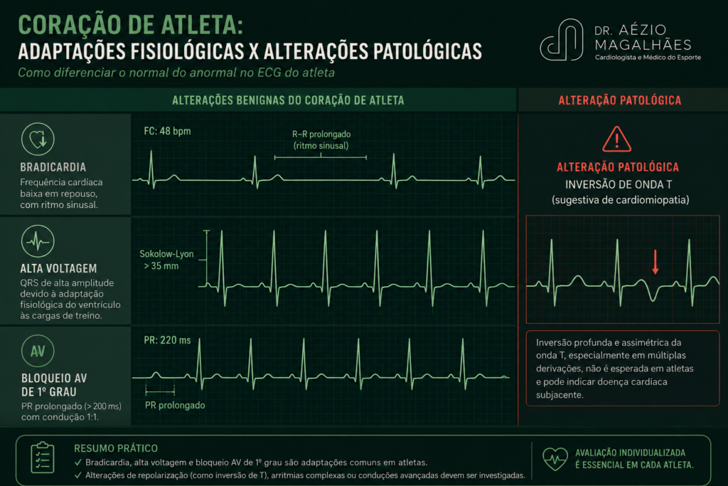 Traçado de eletrocardiograma de atleta com marcações das alterações benignas esperadas e de alterações potencialmente patológicas que exigem investigação